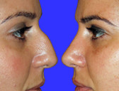 Centro Specialistico di Rinoplastica del Dott. Meneghini Fabio