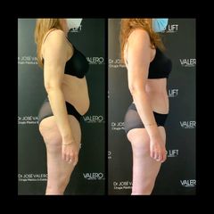Liposucción - Dr. José Valero