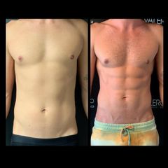 Marcación Abdominal - Dr. José Valero