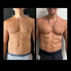 Marcación Abdominal - Dr. José Valero