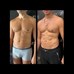 Marcación Abdominal - Dr. José Valero