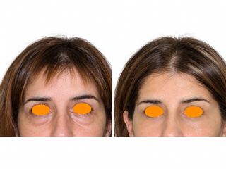 Eliminación de ojeras