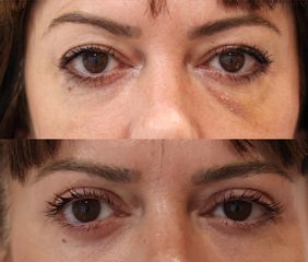 Blefaroplastia completa + resurfacing periocular