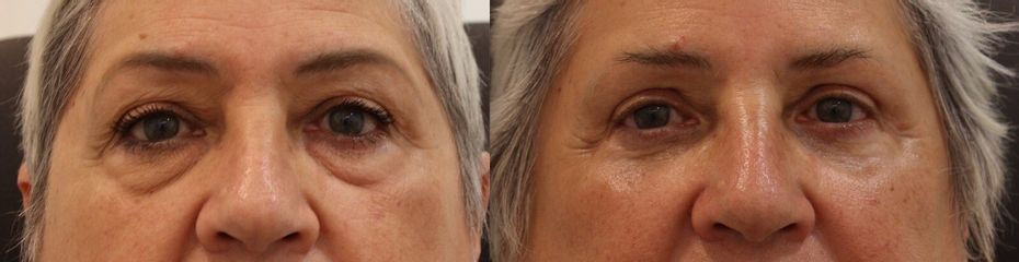 Blefaroplastia completa + resurfacing periocular
