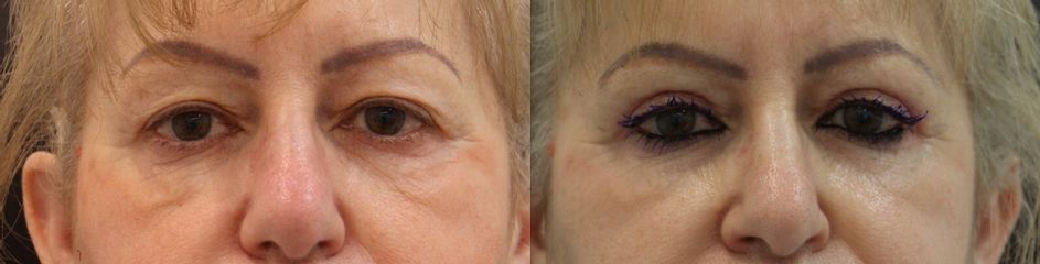 Blefaroplastia superior + resurfacing periocular