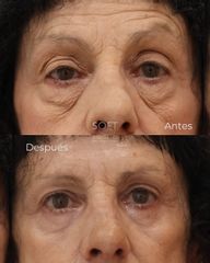 Blefaroplastia completa + Corrección de ptosis palpebral +Resurfacing facial +Radiesse
