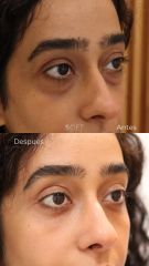 Blefaroplastia inferior transconjuntival