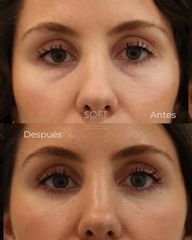 Blefaroplastia inferior
