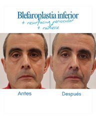 Antes y después de nuestro paciente 👁️ Blefaroplastia inferior ✨ Resurfacing periocular 💉 Radiesse