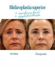 Resultado de nuestra paciente tras blefaroplastia superior + cejaplastia directa + resurfacing