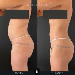 Criolipólisis - Clínica Tufet
