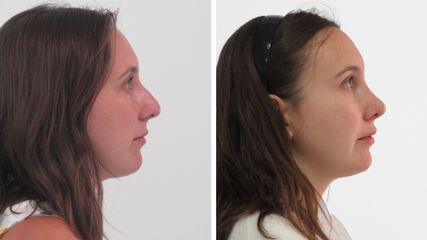 Clínicas Diego De León - Rinoplastia