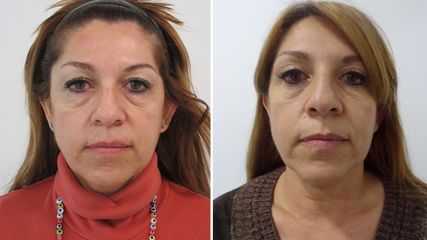 Blefaroplastia completa - Clínicas Diego De León