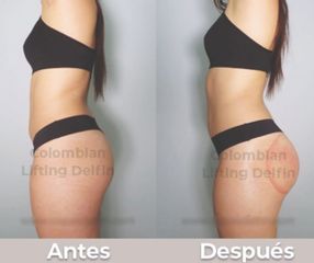 Colombian Butt Lift - Diana Carrillo