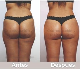 Colombian Butt Lift - Diana Carrillo