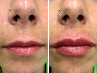Antes y después Aumento labial con Ácido Hialurónico