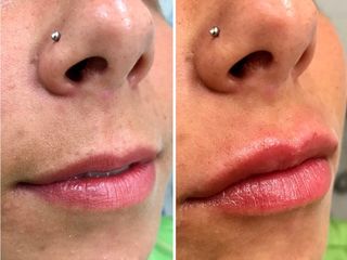 Antes y después Aumento labial con Ácido Hialurónico