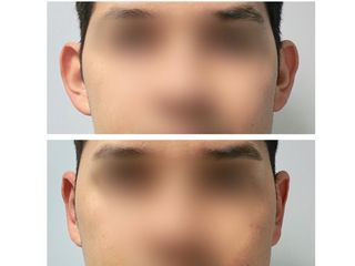 Antes y después otoplastia de reducción 