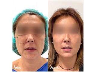 Antes y después lipofilling en: párpado inferior, pómulos, surcos nasogenianos y contorno mandibular