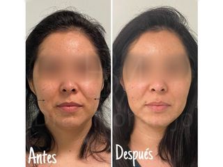 Antes y después Bichectomía