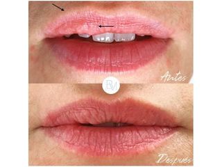 Antes y después Aumento de labios - Dra. Beatriz Moralejo