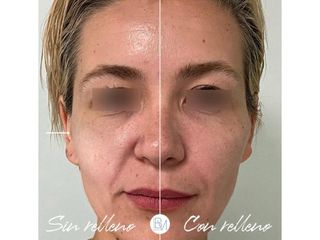 Antes y después Rellenos faciales - Dra. Beatriz Moralejo