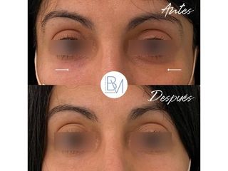 Antes y después Eliminación de ojeras - Dra. Beatriz Moralejo