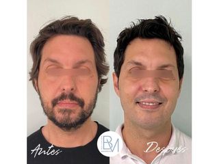 Antes y después Rejuvenecimiento facial - Dra. Beatriz Moralejo