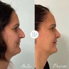 Antes y después Rinoplastia, relleno de ojeras y de labios Dra. Beatriz Moralejo