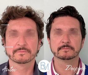 Antes y después Botox en frente y hialuronico en surcos nasogenianos - Dra. Beatriz Moralejo