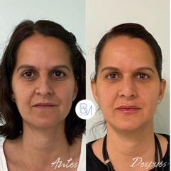 Antes y después Rinoplastia, relleno de ojeras y de labios con hialuronico - Dra. Beatriz Moralejo
