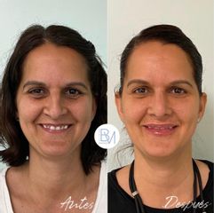 Antes y después Rinoplastia, relleno de ojeras y de labios con hialuronico - Dra. Beatriz Moralejo