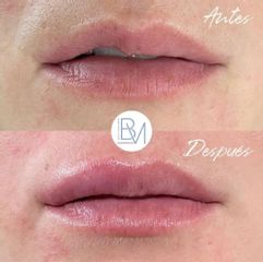 Antes y después Aumento de labios - Dra. Beatriz Moralejo
