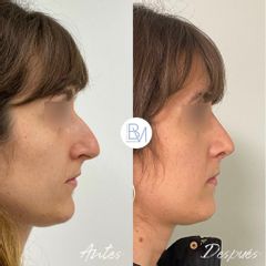 Antes y después Rinoplastia Ultrasónica - Dra. Beatriz Moralejo