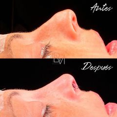 Rinoplastia - Dra. Beatriz Moralejo