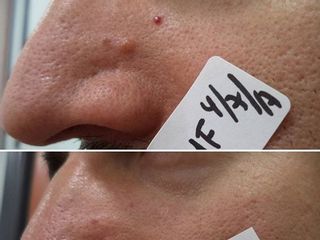Antes y después tratamiento verrugas