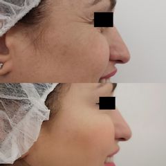 Antes y después Tratamiento antiarrugas- Clínica Bedoya