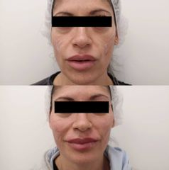 Antes y después Relleno de mejillas, labios y pómulos