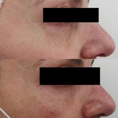 Antes y después Tratamiento bolsas y ojeras - Clínica Bedoya