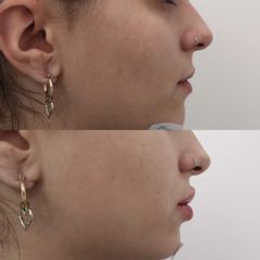 Antes y después Aumento de labios con ácido hialurónico - Clínica Bedoya