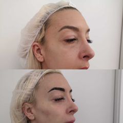 Antes y después  Eliminación de ojeras - Clínica Bedoya