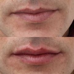 Antes y después Aumento de labios - Clínica Bedoya