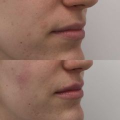 Relleno de labios sútil con ácido hialurónico - Clínica Bedoya
