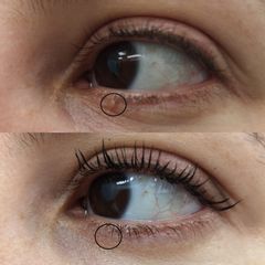Eliminación de verruga- Clínica Bedoya