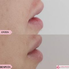 Aumento de labios - Clínica Bedoya