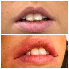 Aumento de labios - Dr. Carlos Miera