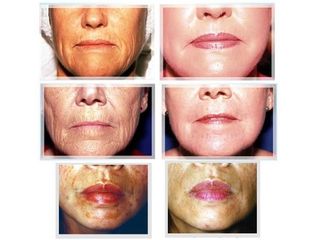 Peeling - Dr. Carlos Miera