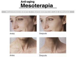 Mesoterapia - Dr. Carlos Miera