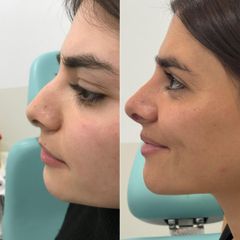 Dr. Carlos Miera - Rinoplastia