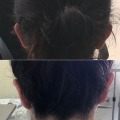 Dr. Carlos Miera - Otoplastia